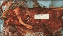 abortion prochoice